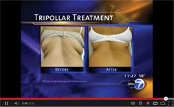 Alpha-Weight-Orlando-Treats Cellulite Video link